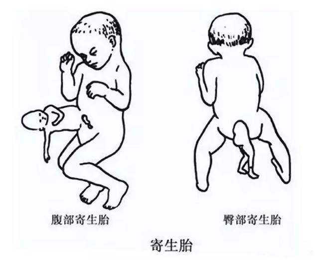 生孩子是从哪个部位生出来的，宫外孕的概率有多大（注定被“割”下的寄生胎）