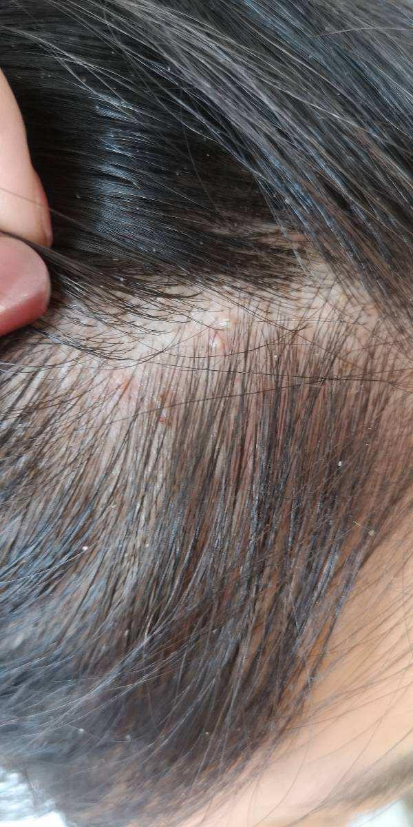 头皮痒是什么原因怎么解决,头屑多,头痒,脱发竟是真菌在搞鬼