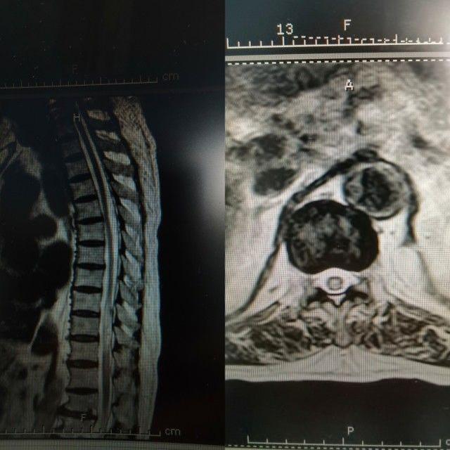 关于脊髓疾病介绍，脊柱脊髓疾病的诊断和治疗（下肢麻木无力未重视）