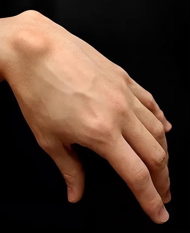 手背腱鞘囊肿图片，手背腱鞘囊肿自愈最佳方法（手背上凸起的肿块被我捏瘪了）