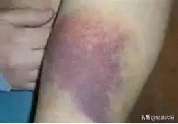 动车退票手续费新规定2022，2022年火车退票手续费新规定是什么（关爱血友病患儿）