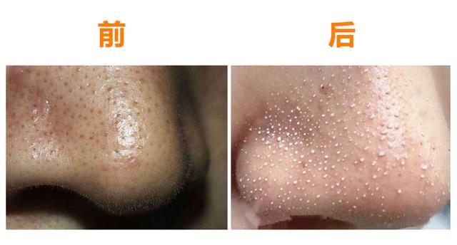小气泡标准操作流程，美容机构的小气泡去黑头效果好吗