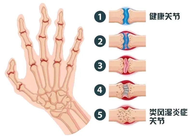 手指关节痛警惕四种病,造成手指关节疼痛的原因有哪些 