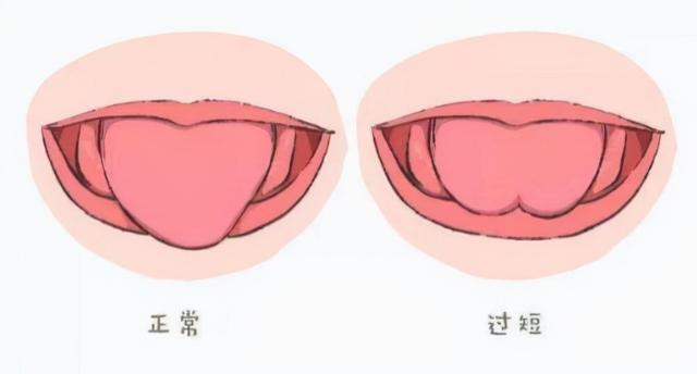 舌系带手术，舌系带手术最佳时间（孩子“大舌头”，必须挨这一刀）