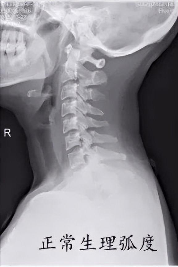 颈椎侧弯怎么矫正，颈椎病生理弯曲消失了怎么办