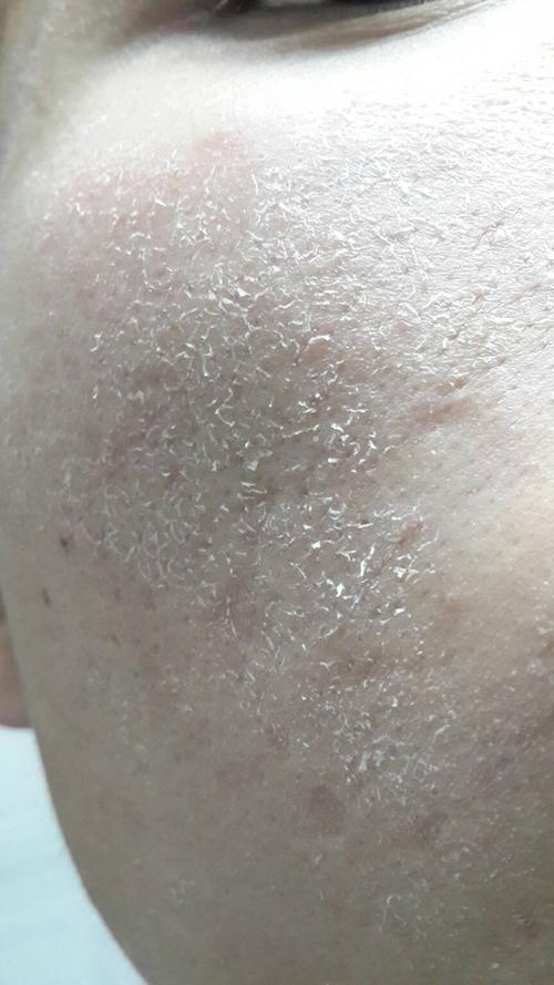 脸部能天天热敷吗，热敷脸有哪些功效与作用（面膜可以天天敷吗）