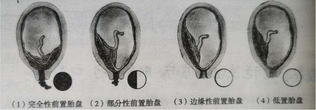 怀孕28周注意事项，怀孕第28周的注意事项（我差点失去了宝宝...）