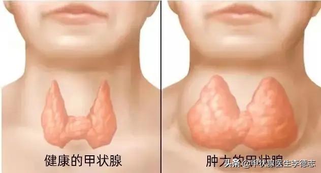 甲状腺肿的治疗，甲状腺肿大治疗方法有哪些（怎么才能有效治疗结节性甲状腺肿）