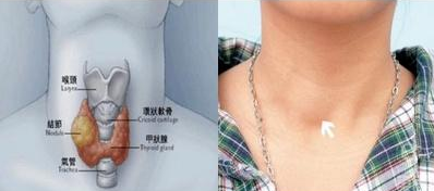 甲状腺4a必须手术吗，甲状腺4a类需要做手术吗（查出甲状腺结节4a类怎么治疗）