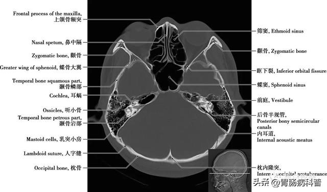 智力扣全套解法图解，智力扣九连环解法（详细标注版——颅脑CT正常解剖图谱）