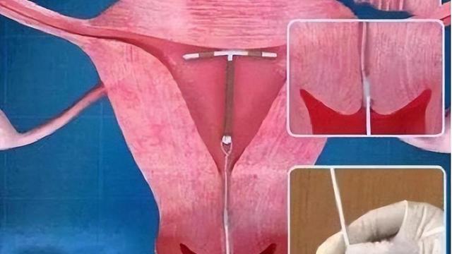 人流手术前要准备什么，人流手术前要准备什么东西（节育环一直不取出来）
