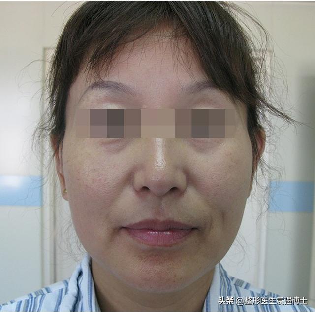 面部提升除皱的原理，面部除皱效果（面部除皱这3种方法还不错）