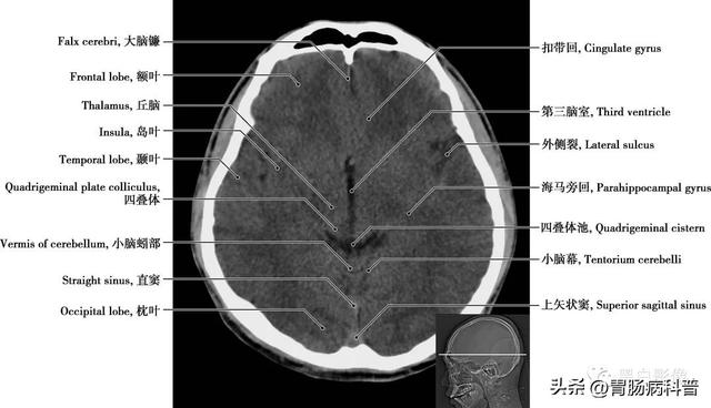 智力扣全套解法图解，智力扣九连环解法（详细标注版——颅脑CT正常解剖图谱）