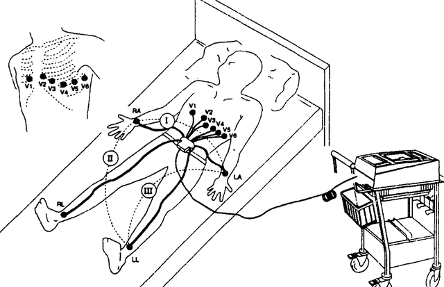 心脏癌最严重的肿瘤，得上心血管肉瘤，比癌症还可怕