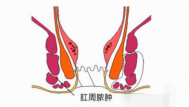 羞涩的意思，囊中羞涩的意思（“六亲不认”的肛周脓肿）