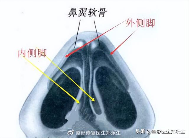 鼻头缩小术千万别做，鼻缩小手术千万别做（肉鼻子做了鼻头缩小结果越“缩”越“大”）