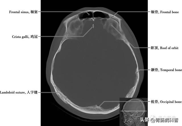 智力扣全套解法图解，智力扣九连环解法（详细标注版——颅脑CT正常解剖图谱）