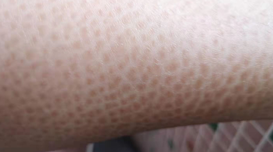 皮肤角化症怎么治，毛囊角化症怎么治疗（但可以通过治疗缓解）