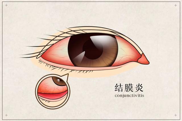 小孩眼睛痒处理小窍门，小孩眼睛痒老是揉眼睛怎么办（孩子眼睛突然红肿、瘙痒）