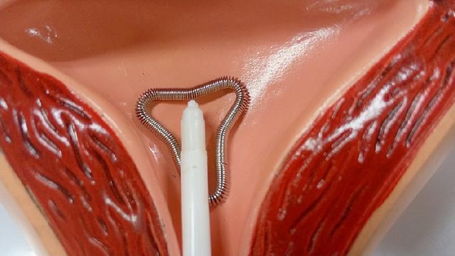 人流手术前要准备什么，人流手术前要准备什么东西（节育环一直不取出来）