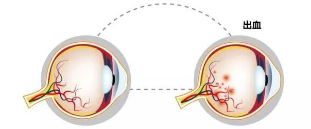 眼球出血怎麼辦,眼球出血是什麼原因引起的(眼底出血莫要慌)