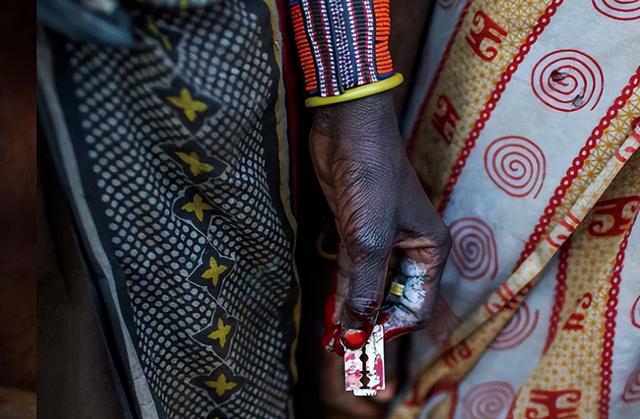 什么叫割礼，什么叫割礼手术（1.3亿人遭受的割礼之痛）