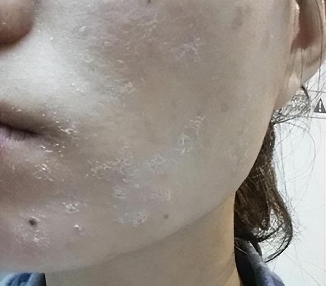 脸部能天天热敷吗，热敷脸有哪些功效与作用（面膜可以天天敷吗）