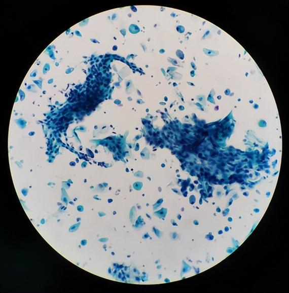 【图片解读】tct报告怎么看?