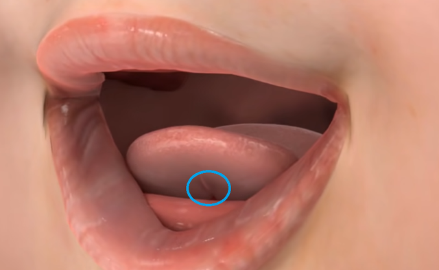 舌系带手术，舌系带手术最佳时间（孩子“大舌头”，必须挨这一刀）