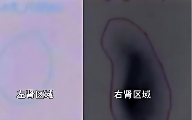 偷肾事件是假的，肾被医院偷了就真的吗（陕西女子体检发现左肾丢失）