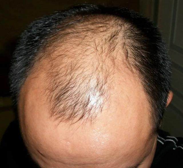 种植牙后如何护理 种植牙会有后遗症吗，种植牙后如何护理（植发要花“一套房”）