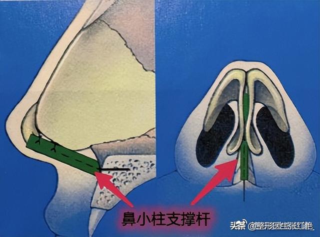 鼻孔大怎么办，鼻子太大怎么自然缩小（成功改造后气质“大变样”）