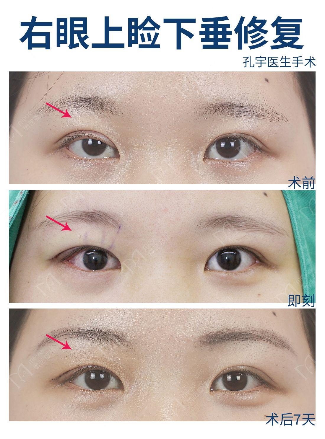 改善提案案例大全图片（姑娘大小眼明显做过一次矫正效果不好）