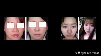 鼻翼肥大怎么办，鼻翼肥大怎么改善（如何改善鼻头圆和鼻翼宽）