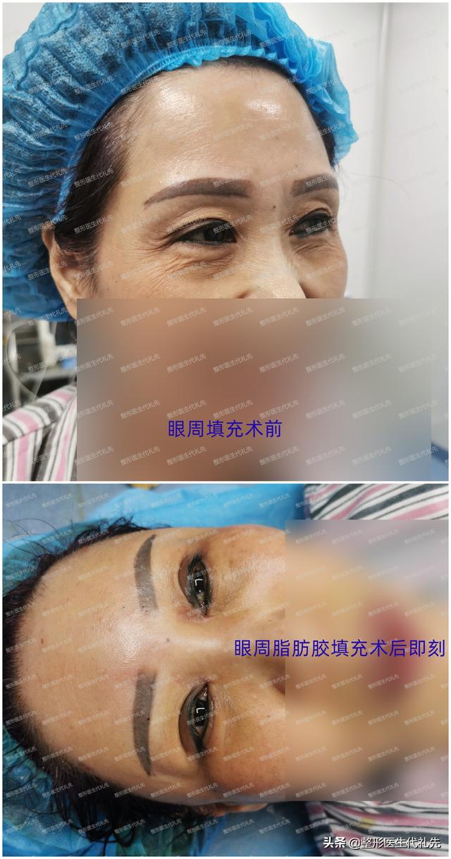 如何去除细纹，如何去除细纹和皱纹（整形医生总结<4点实用方案>）