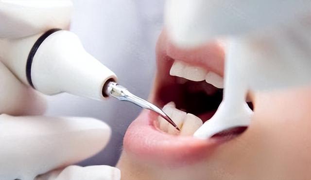 洗牙会对牙齿造成伤害吗，洗牙对牙齿有伤害吗（洗牙会损伤牙齿吗）