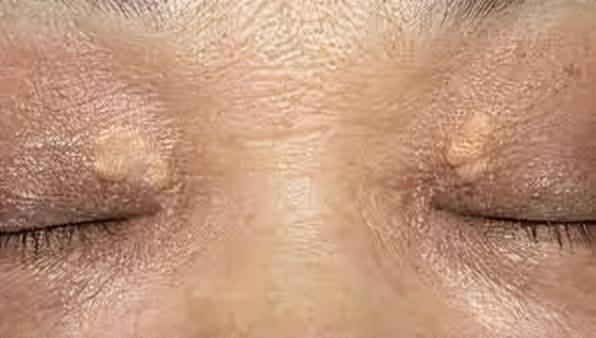 眼周起的小疙瘩别忽视!这种预示了严重疾病-质信十强榜