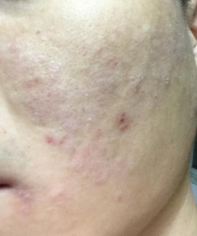 脸部能天天热敷吗，热敷脸有哪些功效与作用（面膜可以天天敷吗）