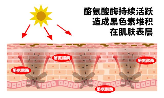 色斑形成的原因,色斑形成的原因生理性(为什么说抑制酪氨酸酶能祛斑)