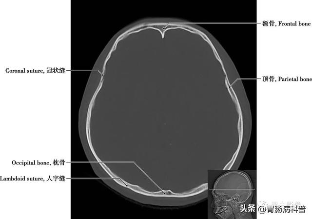 智力扣全套解法图解，智力扣九连环解法（详细标注版——颅脑CT正常解剖图谱）