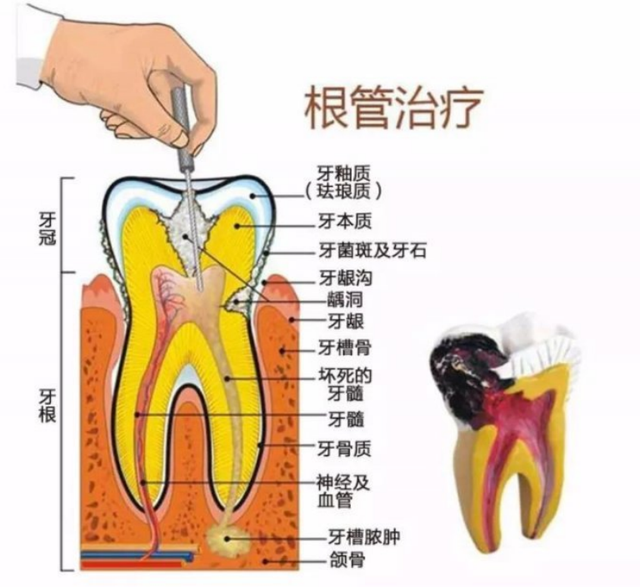 大家要扛住尽量不要做根管治疗，大家要扛住尽量不要做根管治疗有什么说法（为什么人人都害怕根管治疗）