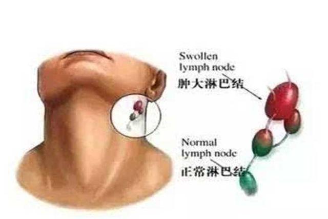 下颚淋巴结肿大怎么回事，孩子下颚淋巴结肿大怎么回事（哪些原因可以引起淋巴结肿大）