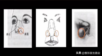 鼻翼肥大怎么办，鼻翼肥大怎么改善（如何改善鼻头圆和鼻翼宽）