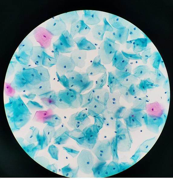 上皮细胞受雌激素轻度到中度影响,此时脱落的细胞以角化前细胞为主