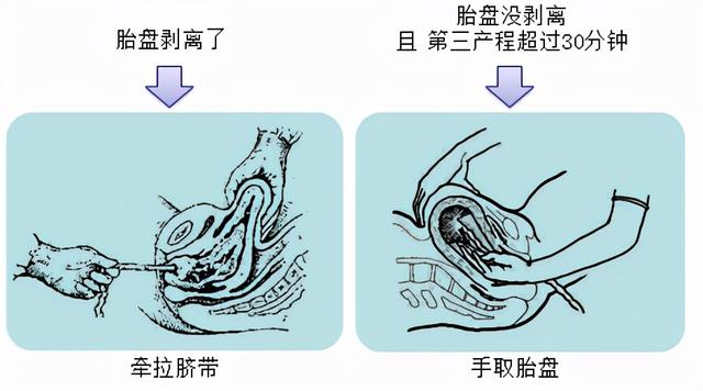 生孩子是突然发动还是有预兆，分娩发动是突然的吗（胎位为什么头先出来是正常）