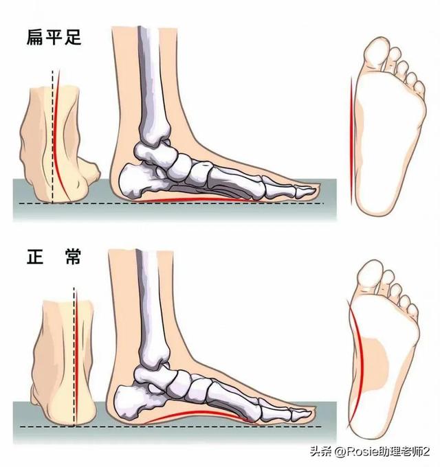 肌肉型小腿怎么办，小腿肌肉该怎么办（沈月瘦了美腿细长直）