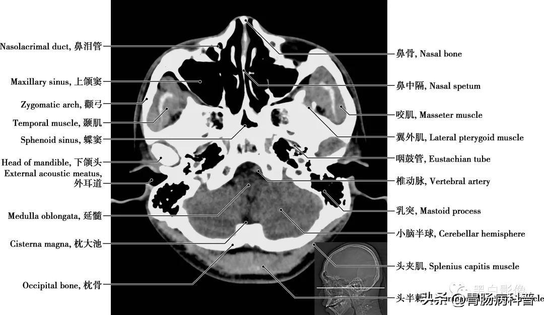 经上矢状窦轴位切面上矢状窦 为单一的硬脑膜静脉窦,位于大脑镰上缘
