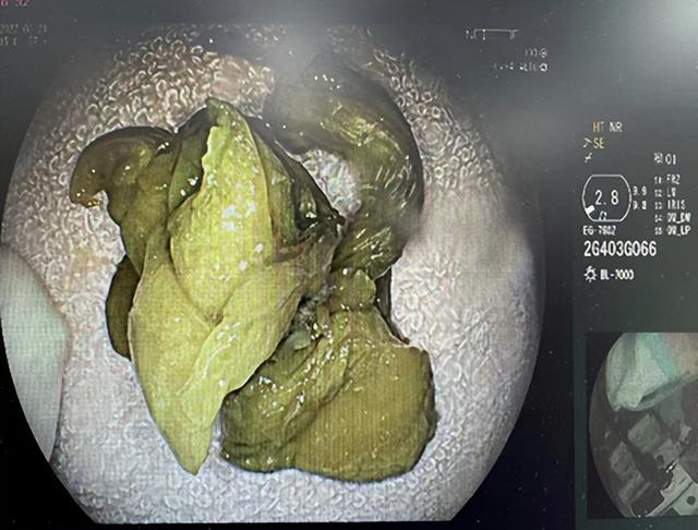 胃堵得慌是什么原因,胃堵得慌是怎么回事(发现胃里堵着一团酸菜)