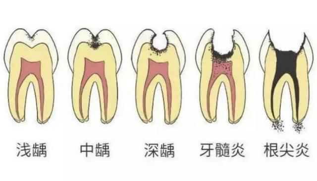 宝宝牙齿蛀牙怎么办，宝宝蛀牙怎么办（儿童“烂牙”需及时处理）