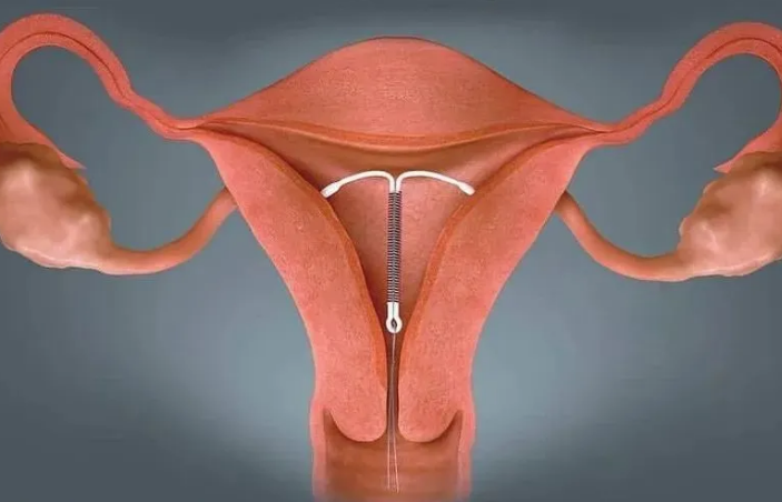 更好的方法是使用宫内节育器,俗称上环